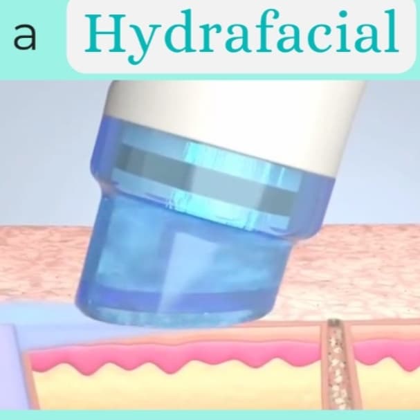Hydrafacial Membership at Phoenix Esthetics in Southington, CT