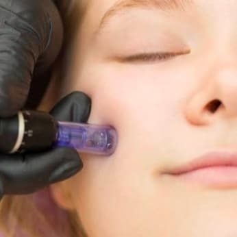 Microneedling package at Phoenix Esthetics in Southington, CT